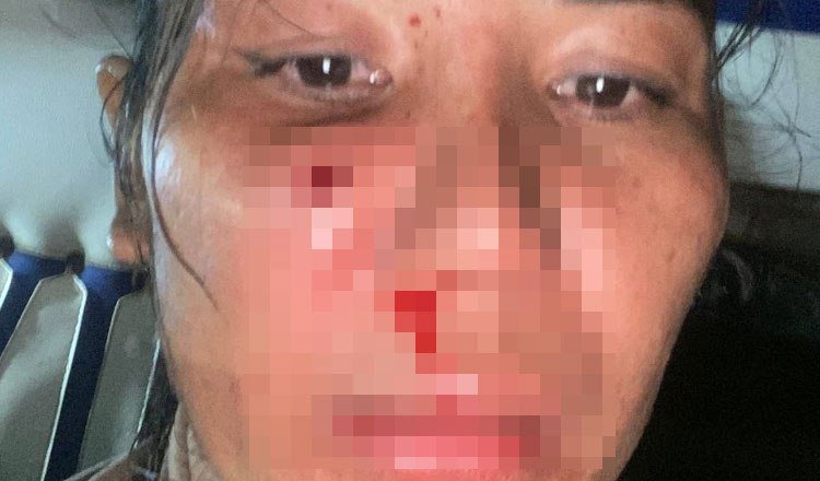 干拉省发生女性遭橡皮子弹射击面部案件 警方介入