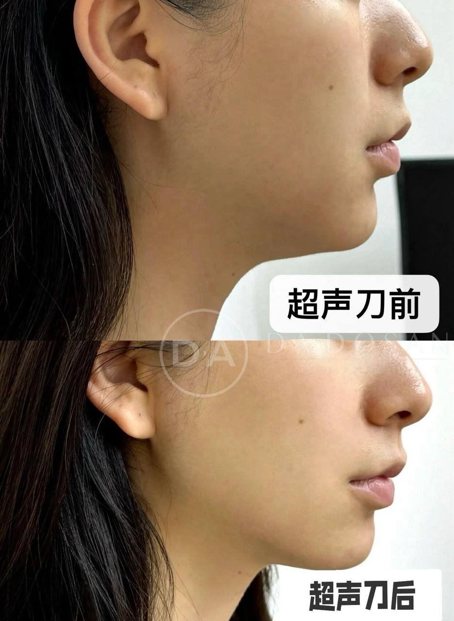 美版二代超声刀转让 $844 保证真机 24小时咨询