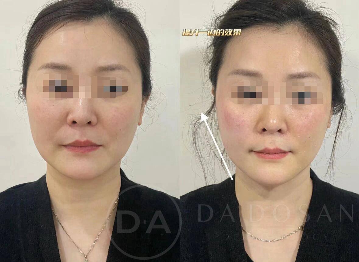 美版二代超声刀转让 $844 保证真机 24小时咨询