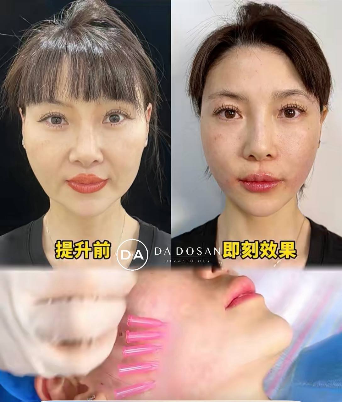 东南亚医美10年老店双11全项目特价 多国连锁