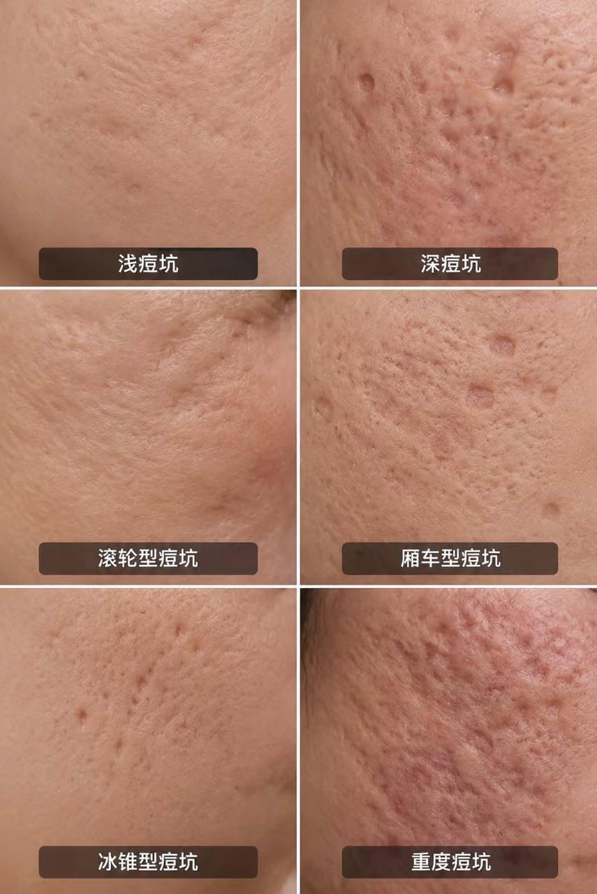 痘坑修复医美服务 金边设分店 微信24小时咨询
