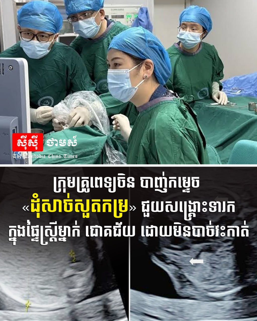 中国医疗团队在柬成功实施罕见胎儿手术