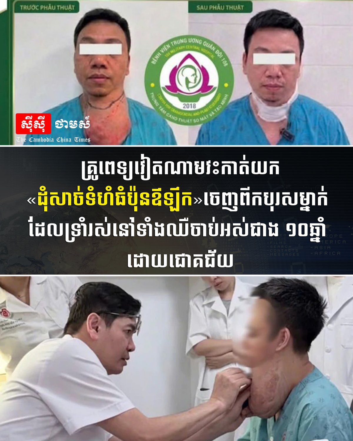 越南医生成功切除患者颈部巨大肿瘤